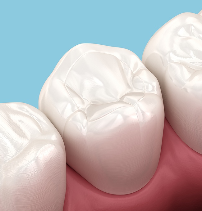 Illustration of tooth-colored composite resin on enamel